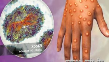 Monkeypox (maymun çiçeği virüsü) 1 monkeypox maymun cicegi virusu NBg9UDEs