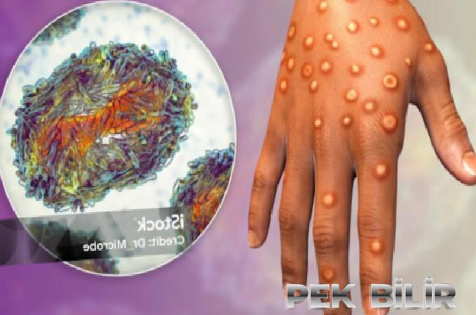 Monkeypox (maymun çiçeği virüsü)